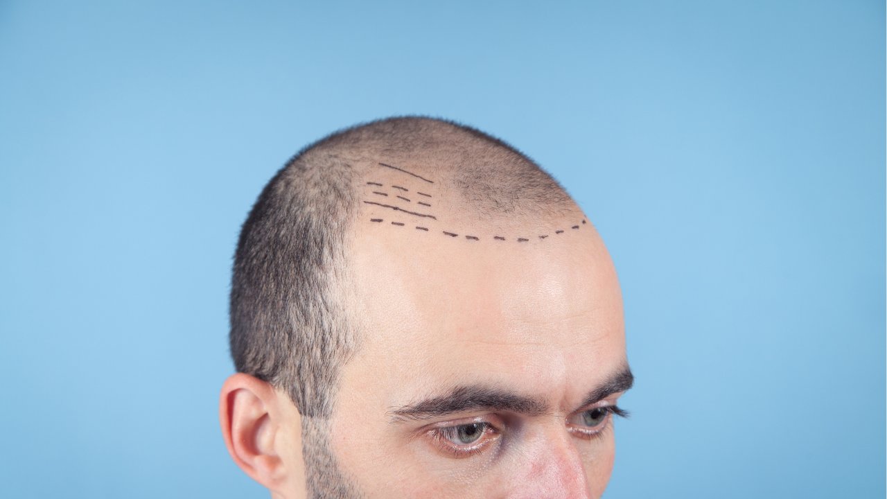 韓国毛髪移植 完全ガイド — FUE vs FUT、非切開 vs 切開、日韓価格・技術比較