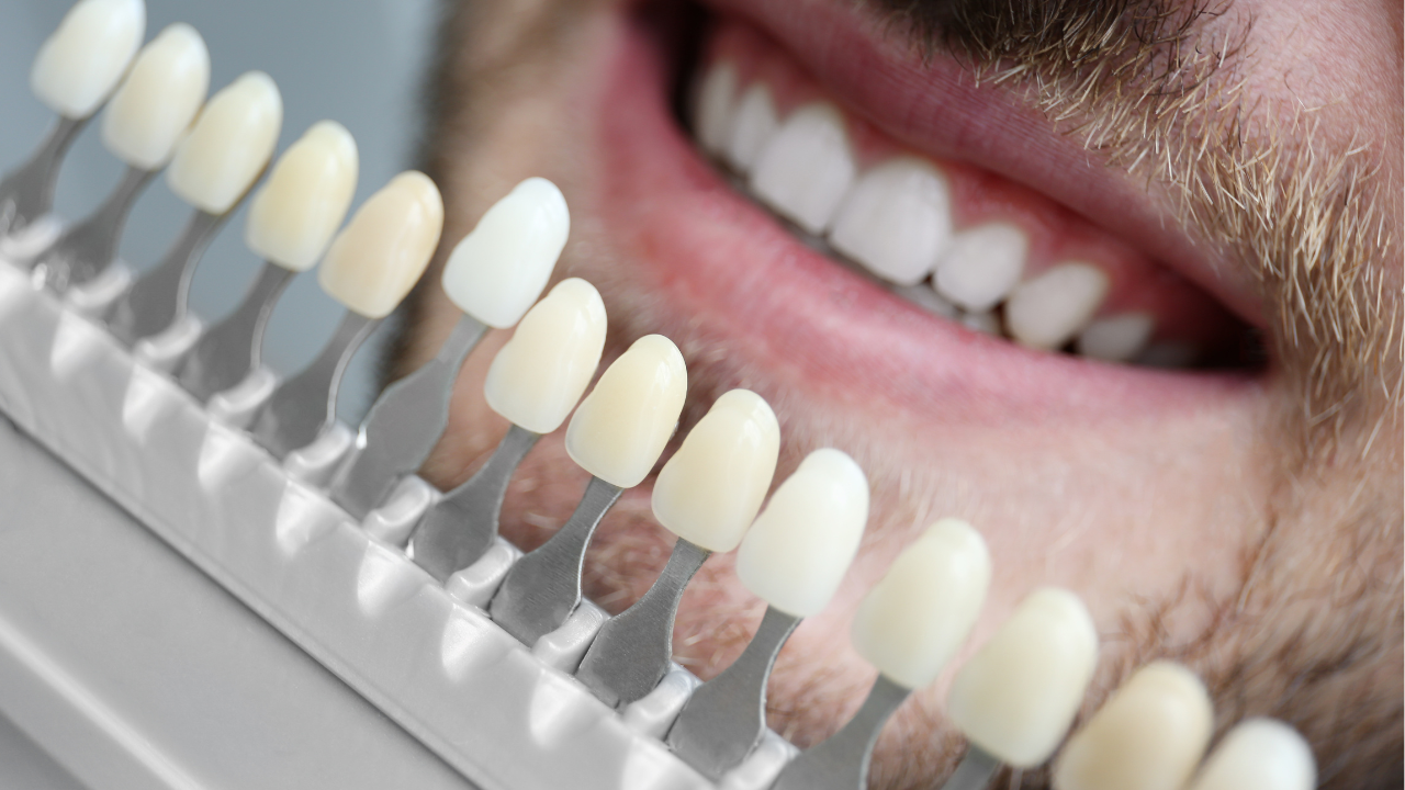 Veneers in Korea | Best Clinics, Cost of Veneers and More, image size:1280x720