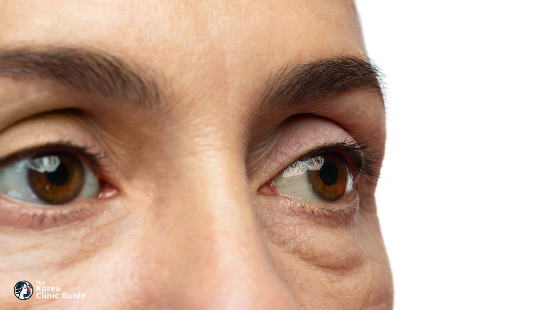 blepharoplasty korea