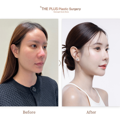 Prominent Cheekbones: Cheekbone Reduction Procedures in Korea for