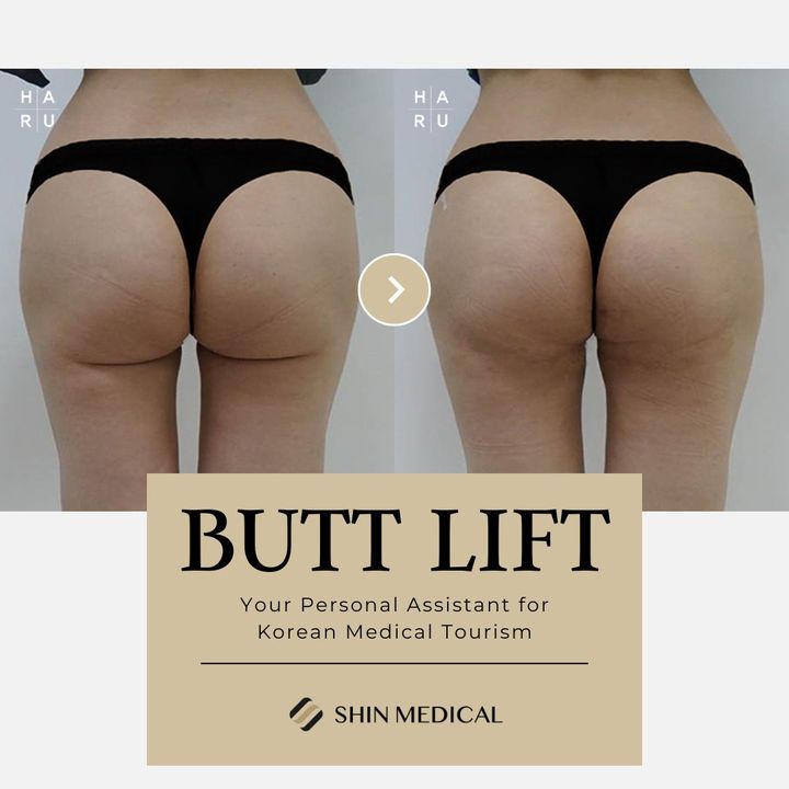 Sagging Buttocks After Weight Loss: Butt Thread Lift Solutions in Korea for  Firm and Lifted Curves