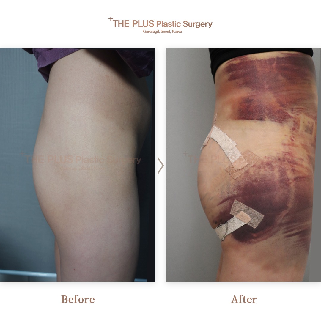 Sagging Buttocks After Weight Loss: Butt Thread Lift Solutions in Korea for Firm and Lifted Curves