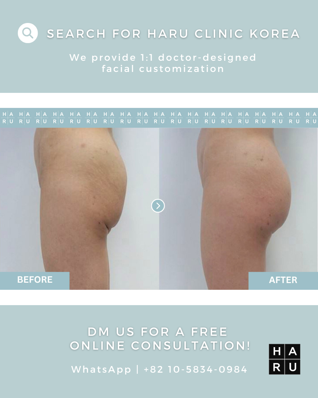 Sagging Buttocks After Weight Loss: Butt Thread Lift Solutions in Korea for  Firm and Lifted Curves