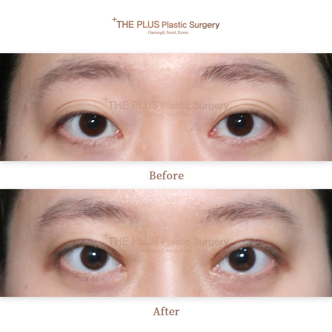 Improve Superior Visual Field in Korea with Expert Double Eyelid